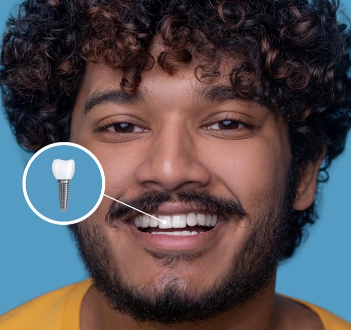 Implantat-tand-vård Implantat-tand-vård