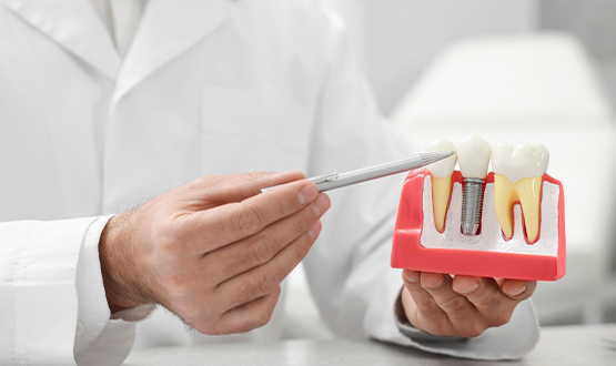 Implantat-konsultation-personlig Implantat-konsultation-personlig